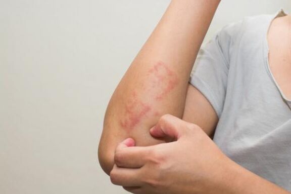 Psoriasia tratatzeko azken metodoak