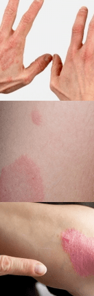 Eskuetako hasierako fasearen psoriasia
