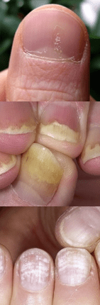 Iltze Psoriasia - Hasierako etapa