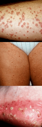 Psoriasia hanketan