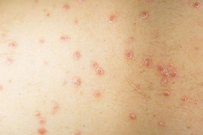 Leku psoriasia sintomak