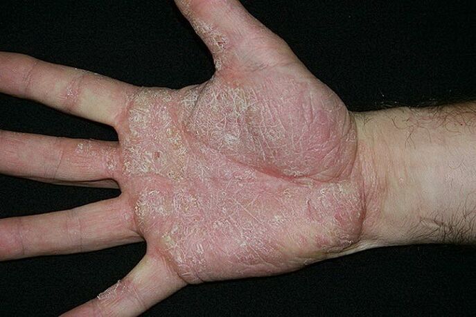palmondoen eta oinen psoriasia