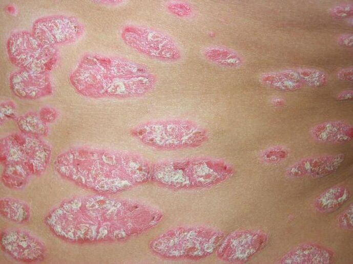 plaka psoriasia