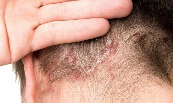 psoriasia buruan