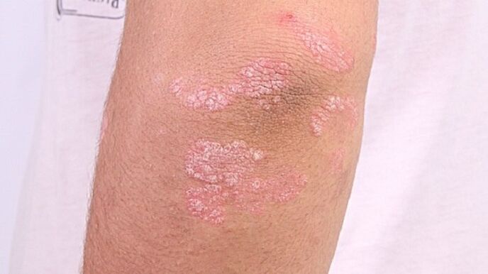 psoriasia hasierako fasearen argazkia