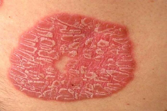 psoriasia pustularra