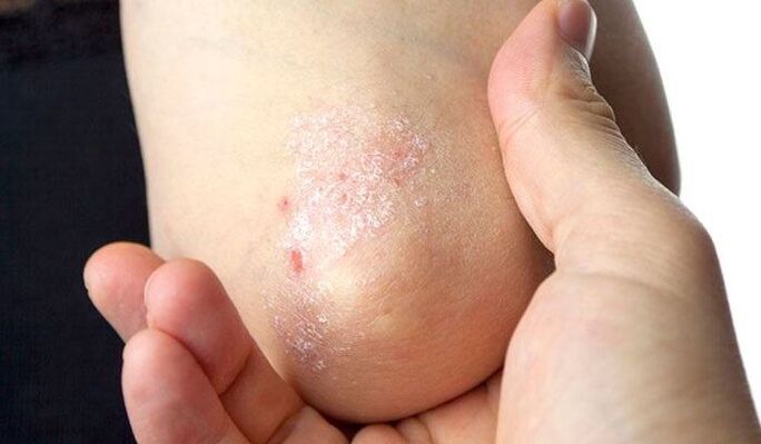 psoriasiaren sintomak hasierako fasean