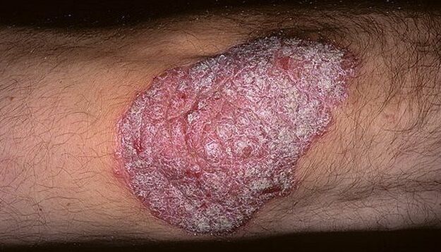 psoriasia