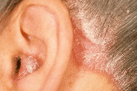 psoriasiaren arrazoiak